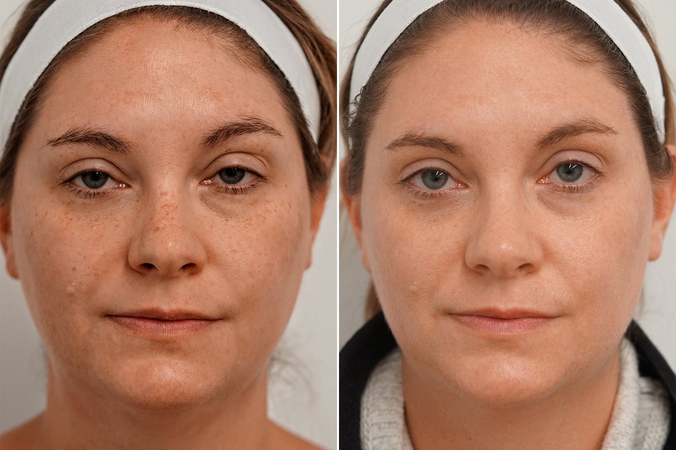 BBL HERO face treatment, before and after