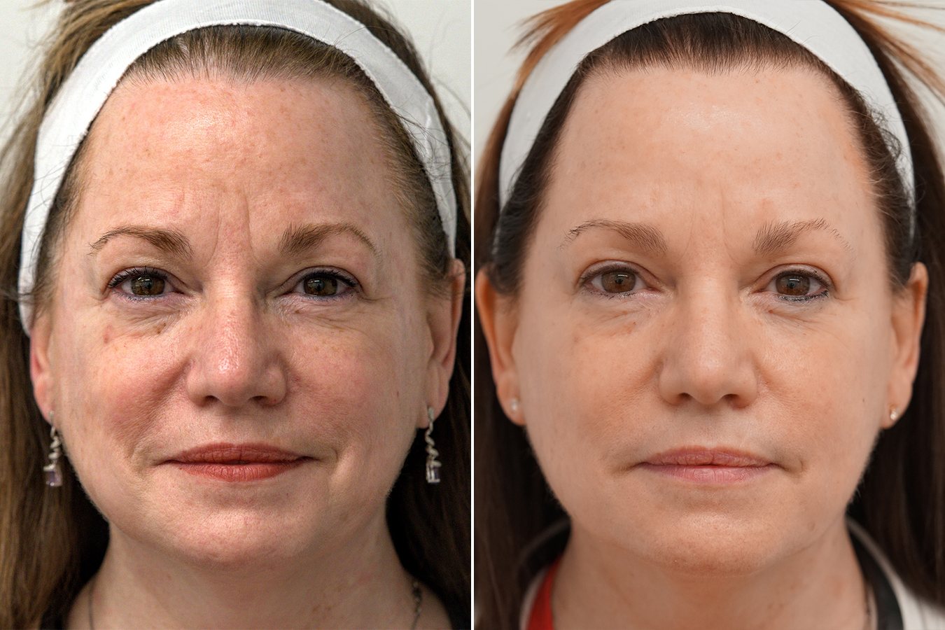 BBL HERO face treatment, before and after