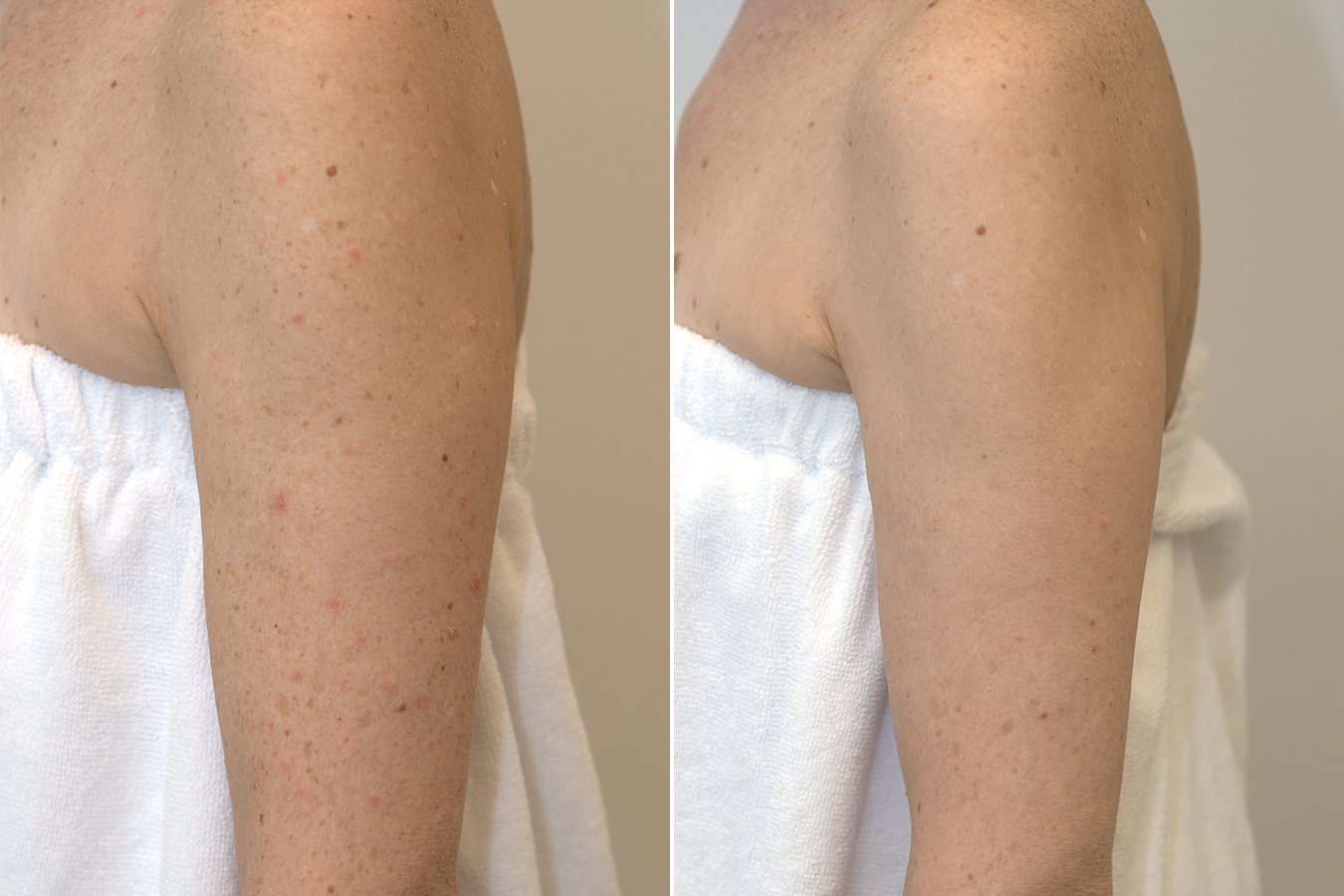 BBL HERO arm treatment, before and after