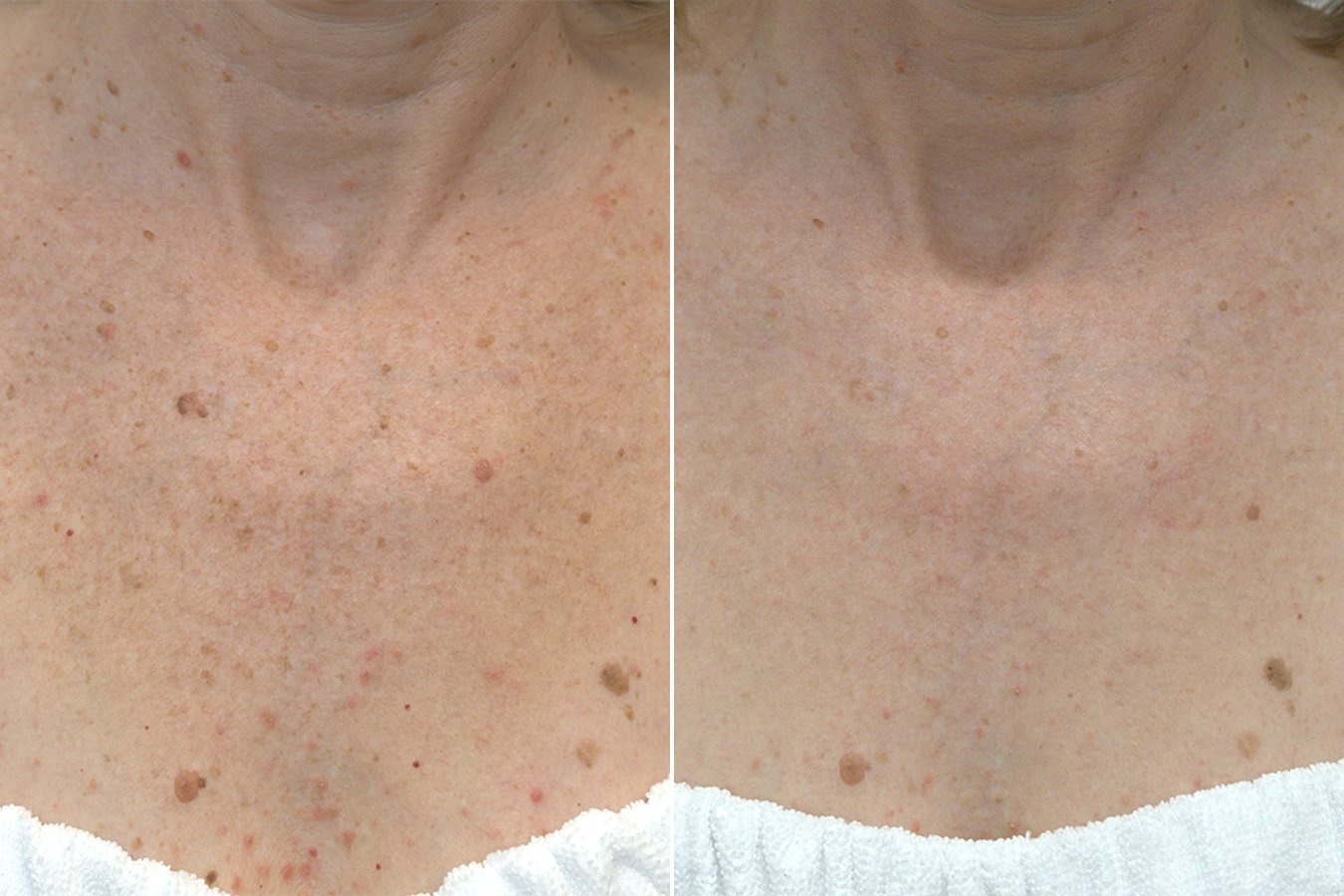 BBL HERO chest treatment, before and after