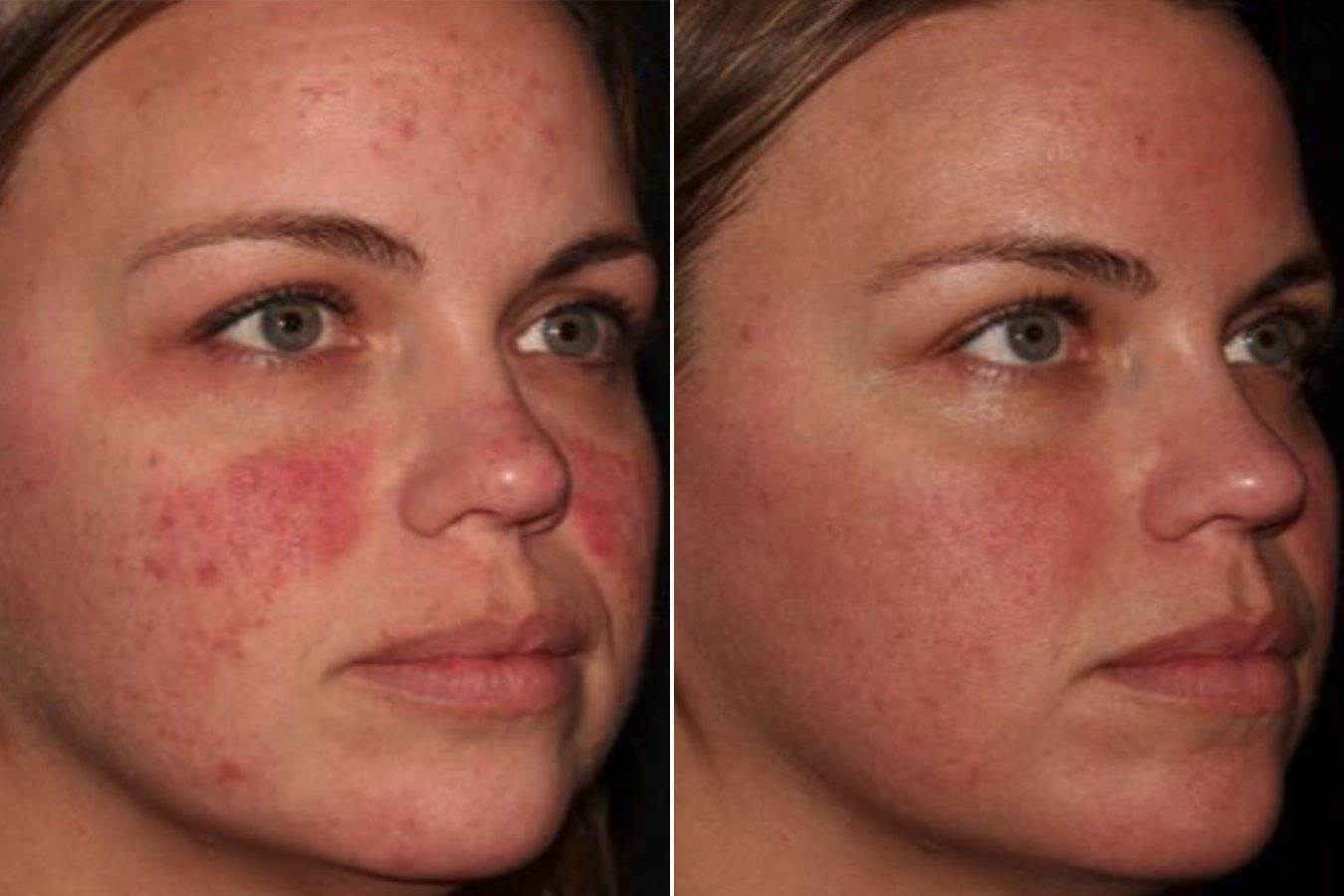 HALO laser treatment for redness, before and after
